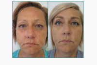 Andlitslyfting með laser er einföld aðgerð